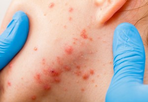 Acne Haarlem. Behandelen weghalen puisten pukkels litteken