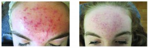 Acne Haarlem pukkel puist velserbroek jeugdpuistjes
