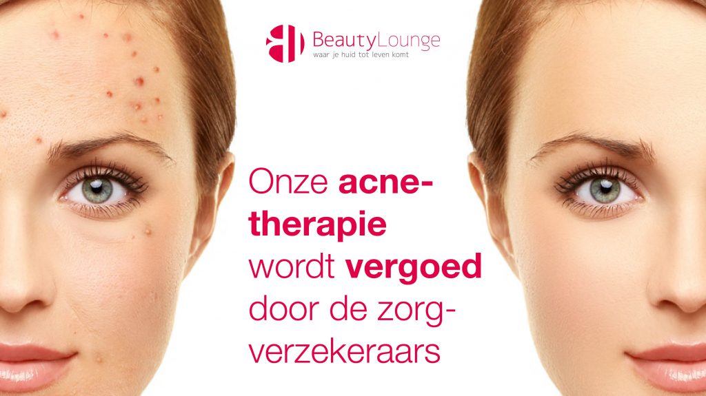 vergoeding acne haarlem bij beauty lounge