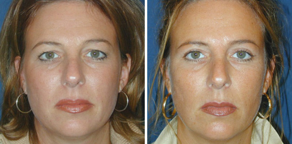 ooglidcorrectie,ooglift haarlem oogleden goedkoop