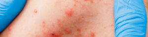 huidverbetering acne jeugd volwassenen puistjes pukkels